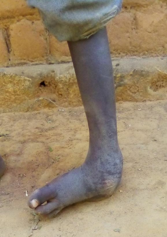 30Klumpfuß Tansania